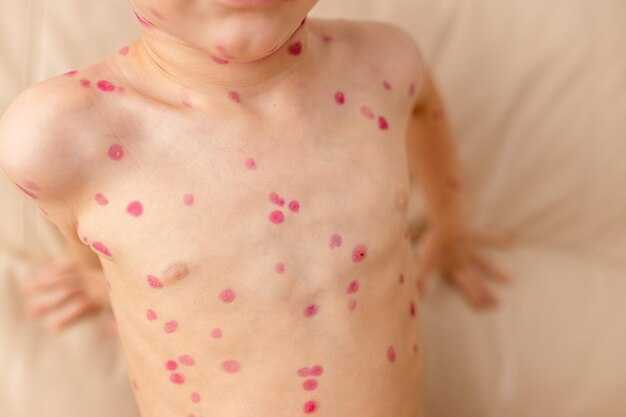 Симптомы сыпи при ВИЧ