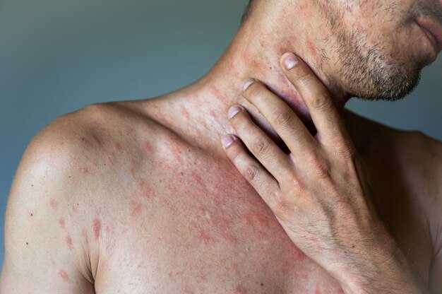 Симптомы кори у взрослых: что нужно знать